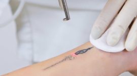 Comment se faire enlever un tatouage ?