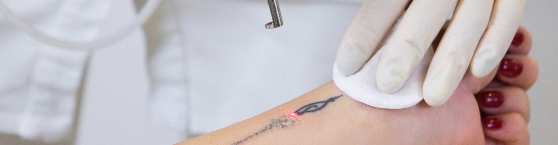 Comment se faire enlever un tatouage ?