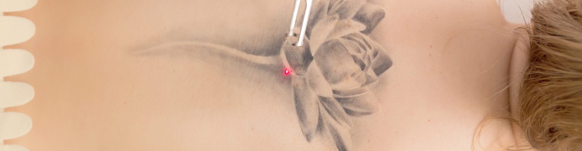 Détatouage
