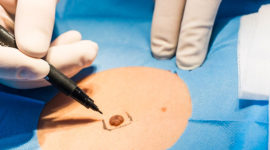 Petite chirurgie dermatologique conventionnée