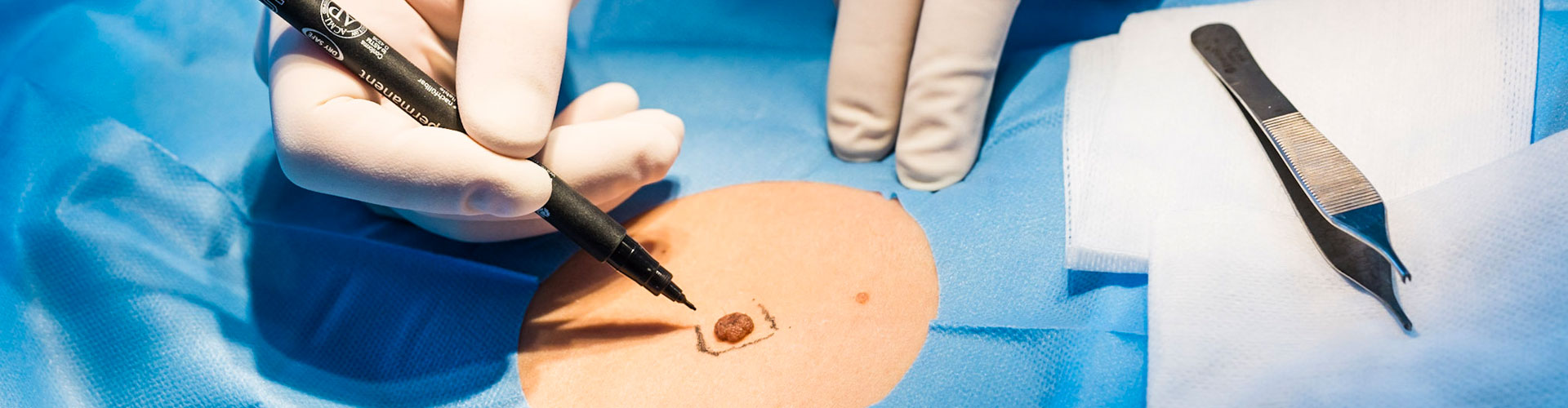 Petite chirurgie dermatologique conventionnée