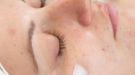 Le peeling est-il efficace contre l’acné adulte ?