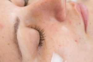 Le peeling est-il efficace contre l’acné adulte ?