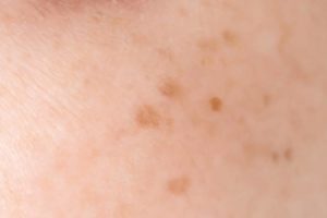 D’où viennent les taches brunes qui apparaissent sur la peau ?
