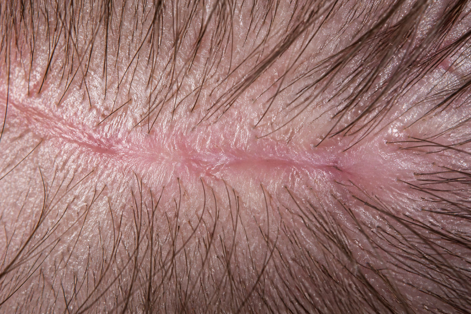 3 méthodes pour préparer le tissu avant l'implantation
